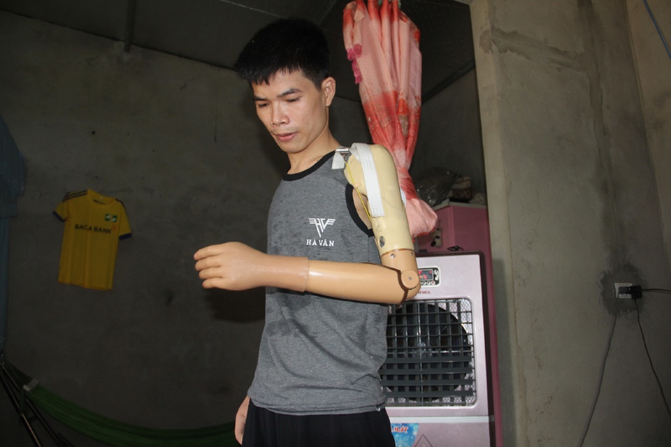 Hạnh phúc tràn ngập của người cha trẻ mất đôi tay chăm con thơ được chắp đôi tay mới - 4 Việc chắp cánh tay điện tử cho Hải gặp nhiều khó khăn, tưởng như sẽ không thể thực hiện được do đôi tay của Hải vì vết thương bị cắt cụt quá ngắn, cơ tay quá yếu. Nhưng may mắn một trong hai cánh tay của Hải vẫn chắp được cánh tay điện tử. Cánh tay còn lại là cánh tay thường.
