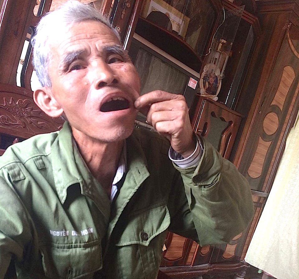 Người lính tù Côn Đảo hơn 20 năm đi tìm công lý! - 1 Hàm răng của ông không còn nguyên vẹn vì bị giặc nhổ đi vì không chịu khai báo.