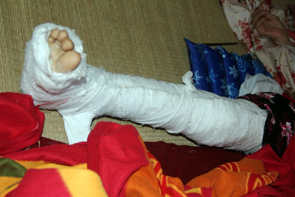 "Bố mất rồi, mẹ đừng bỏ con đi nữa mẹ ơi !" - 4 Chân chị Luận bị gãy khi chị bước xuống xe sau hành trình dài ngày đi chữa bệnh tại Miền Nam.