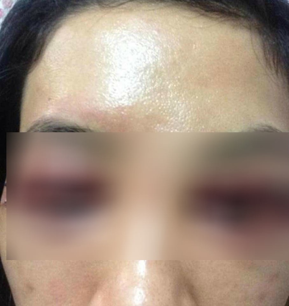 Người phụ nữ tố spa làm mắt bị biến dạng kinh hoàng sau cắt mí - 1 Người phụ nữ tố spa làm mắt bị biến dạng kinh hoàng sau cắt mí - 1