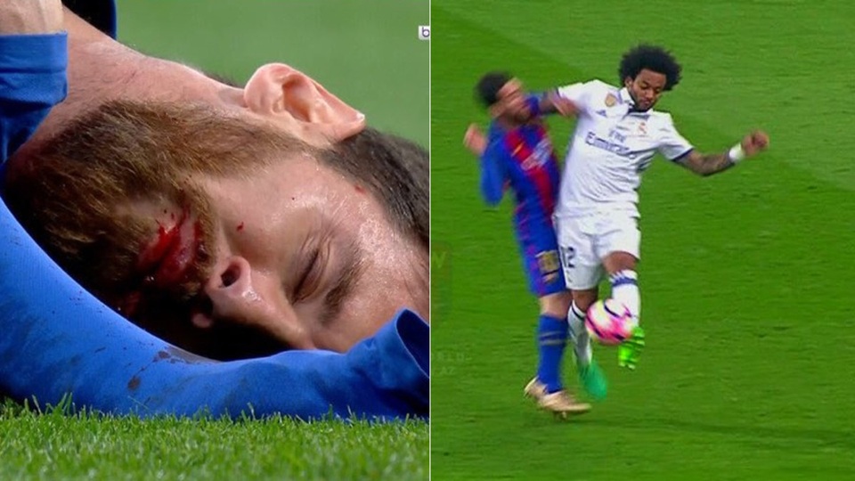 Messi bị thúc cùi chỏ, chảy máu mồm ở trận Siêu kinh điển - 1 Messi đổ máu sau pha thúc cùi chỏ với Marcelo