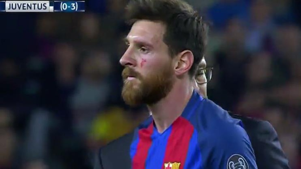 Messi ngã dập mặt và rách má trong ngày buồn của Barca - 2 Rất may Messi chỉ bị rách ở vùng má