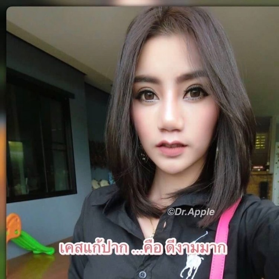 Phụ nữ Thái đua nhau phẫu thuật để có "môi sừng trâu" - 2 Phụ nữ Thái đua nhau phẫu thuật để có "môi sừng trâu" - 2