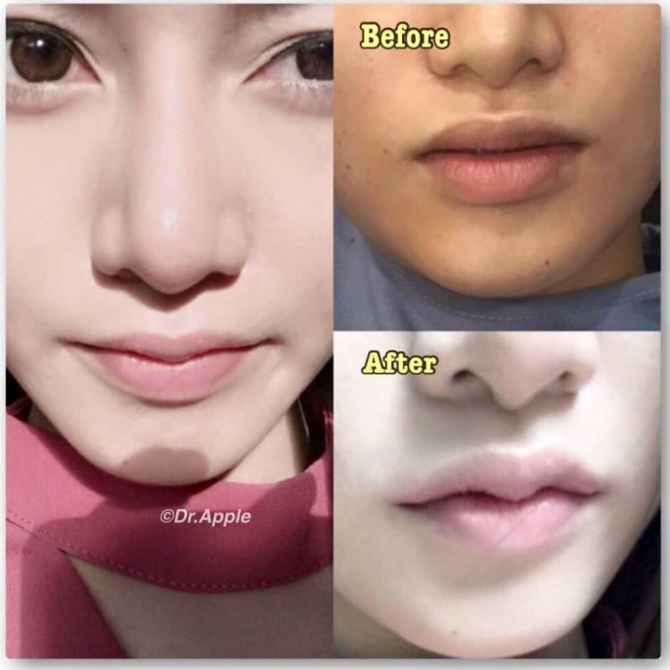Phụ nữ Thái đua nhau phẫu thuật để có "môi sừng trâu" - 4 Phụ nữ Thái đua nhau phẫu thuật để có "môi sừng trâu" - 4