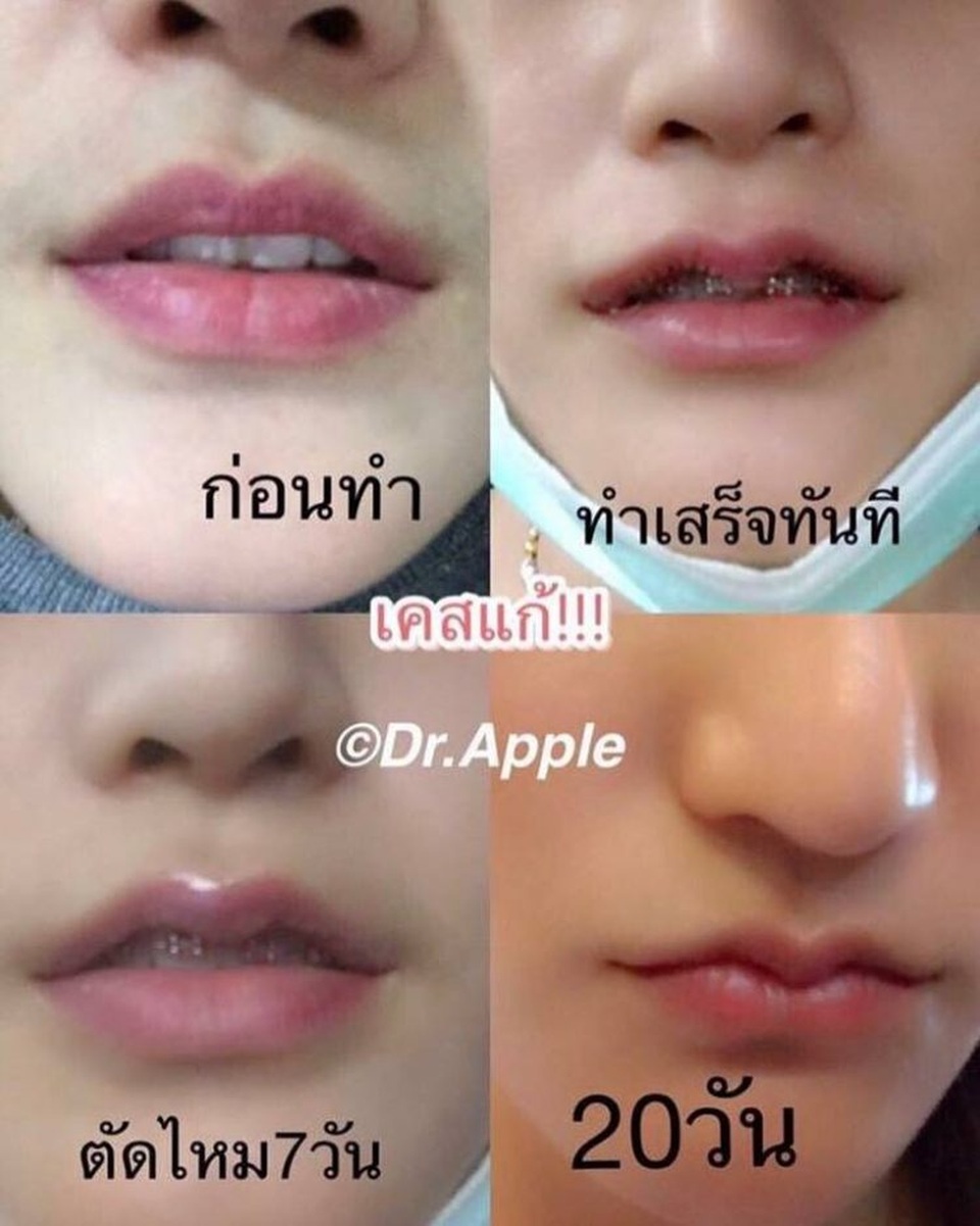 Phụ nữ Thái đua nhau phẫu thuật để có "môi sừng trâu" - 3 Phụ nữ Thái đua nhau phẫu thuật để có "môi sừng trâu" - 3