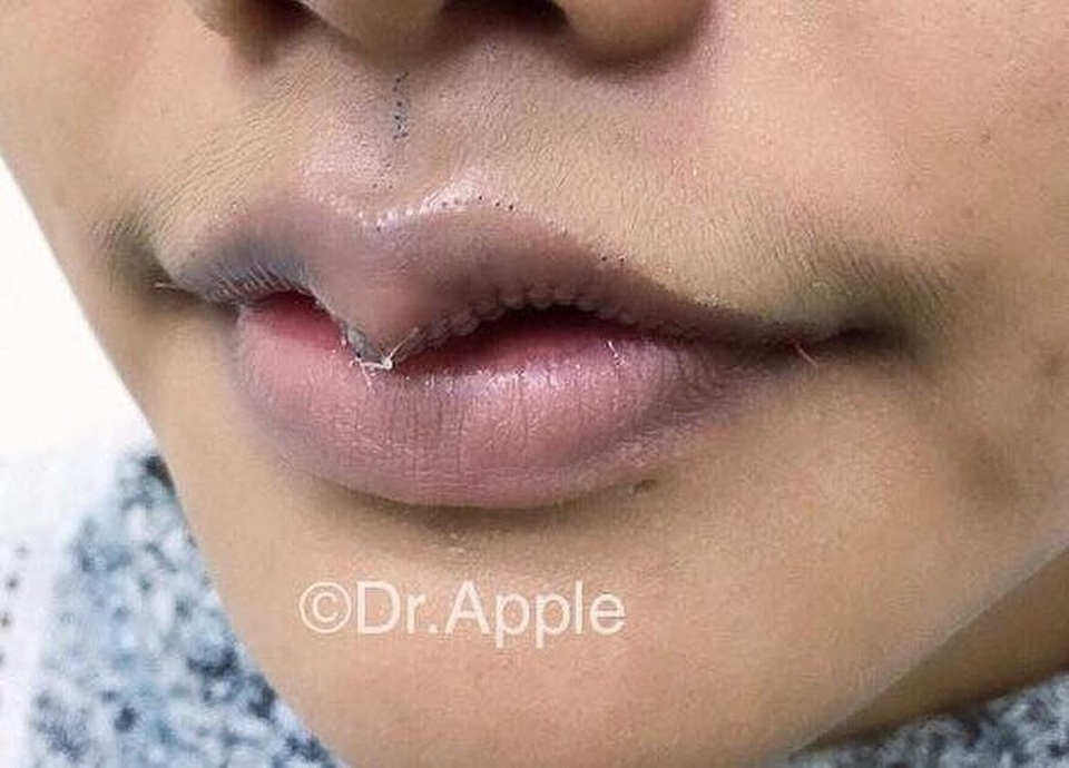 Phụ nữ Thái đua nhau phẫu thuật để có "môi sừng trâu" - 6 Phụ nữ Thái đua nhau phẫu thuật để có "môi sừng trâu" - 6