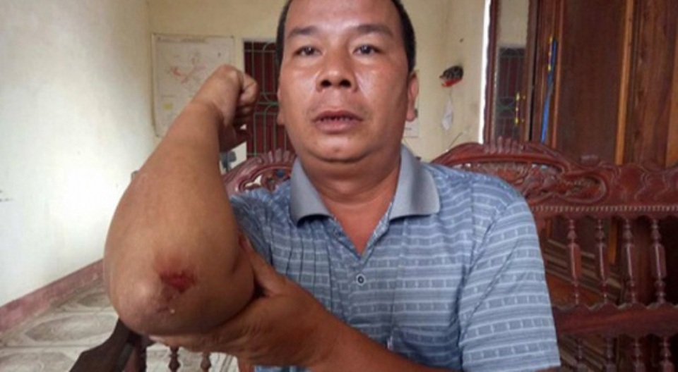 Trưởng công an xã bị tấn công khi ngăn cản cát tặc - 1 Anh Sỹ, người dân cũng bị ông Giang đánh kể lại sự việc