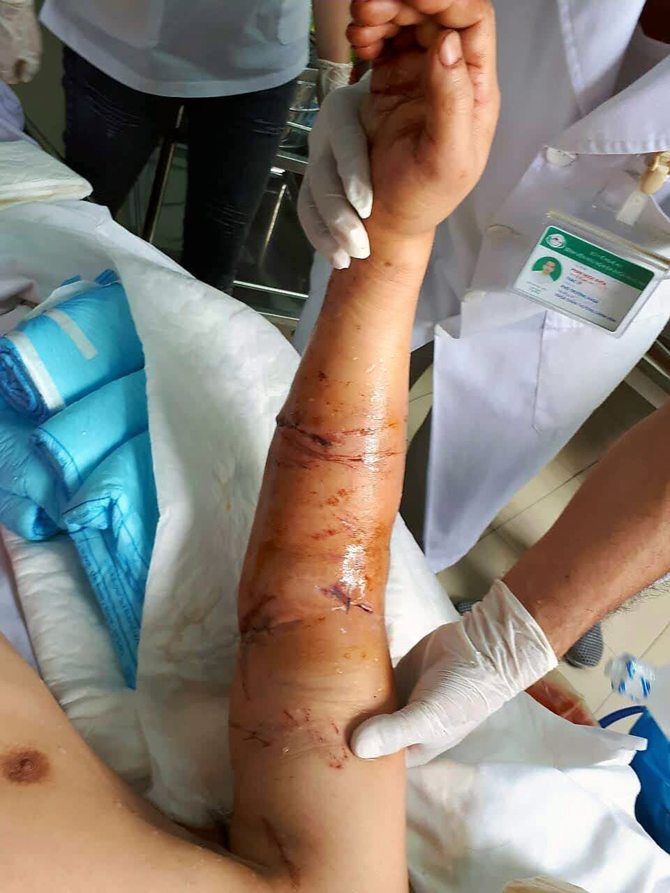 Nối thành công cánh tay thầy giáo bị tai nạn đứt gần hết - 3 Hiện cánh tay phải của thầy N. đã được nối thành công và tiến triển rất tốt.