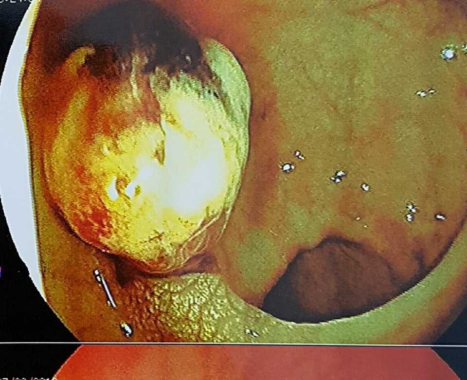 Cảnh giác dấu hiệu đi ngoài ra máu ở trẻ nhỏ - 2 Hình ảnh polyp trên đường tiêu hóa của một bệnh nhi được phát hiện nhờ nội soi. Ảnh: BS cung cấp.