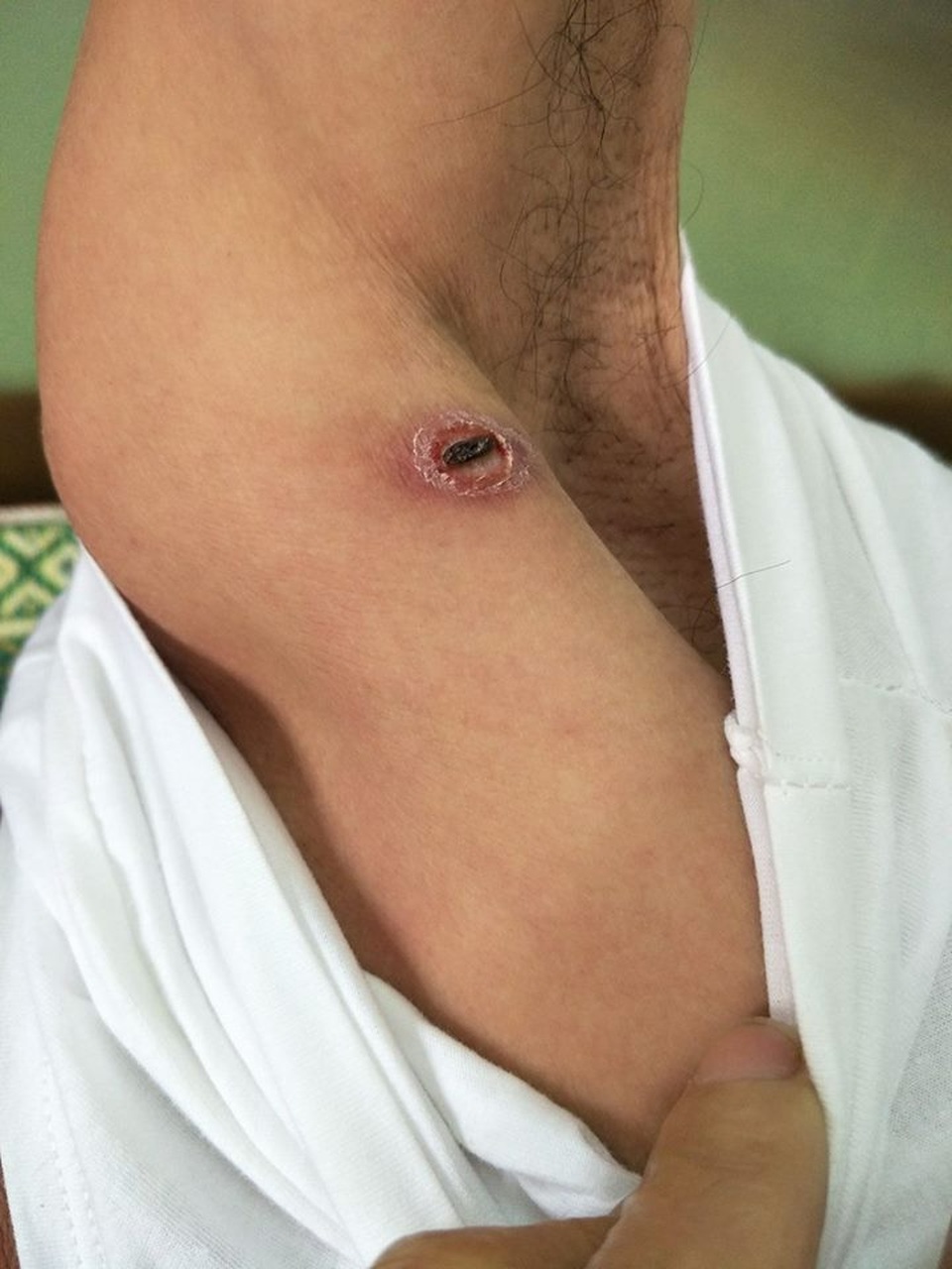 Cảnh giác sốt từng cơn kéo dài sau khi đi phượt rừng núi - 1 Vết mò đốt vùng nách của bệnh nhân chỉ được phát hiện khi bác sĩ thăm khám. Ảnh: Hải Yến