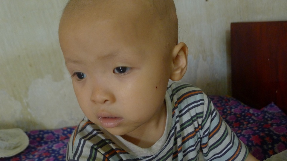 Ánh mắt đáng thương của cô bé 3 tuổi bị ung thư thận - 2 Bé Linh (3 tuổi) phát hiện căn bệnh ung thư thận đã di căn phổi từ năm 2016.