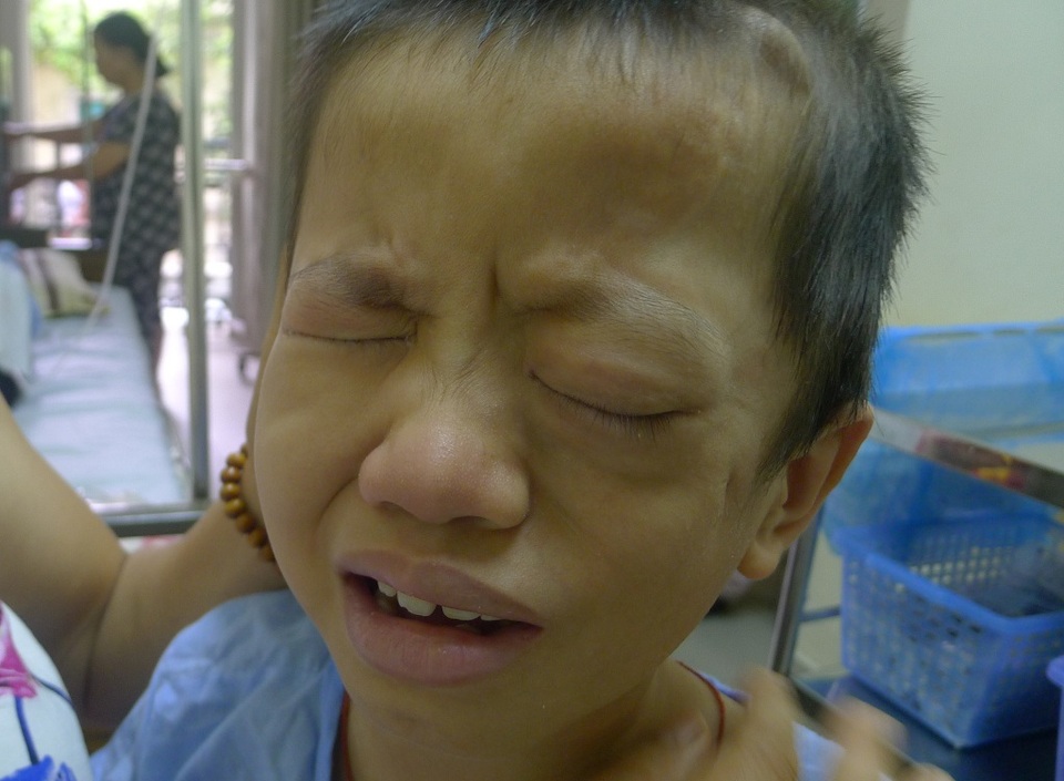 Bé Hoàn bị phình động mạch cảnh trong khổng lồ đã được phẫu thuật thành công - 1 Bị phình động mạch cảnh trong khổng lồ với kích thước từ 10x12cm khiến tính mạng của cậu bé Hoàn vô cùng nguy kịch.