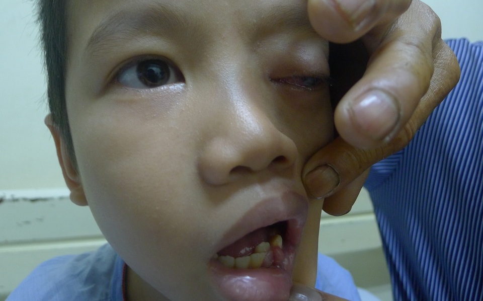 Bé 8 tuổi nguy kịch tính mạng vì phình động mạch cảnh khổng lồ - 4 Căn bệnh khiến em mọc u ở khắp mọi nơi, cả kể trong miệng.