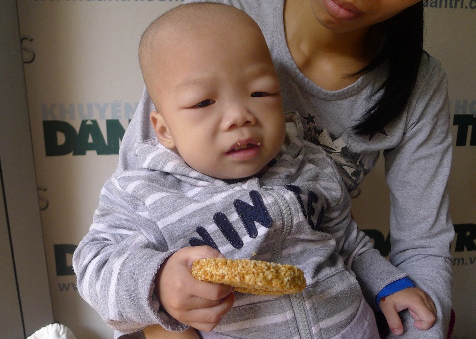 Cậu bé dân tộc Tày bụng to như cái trống tiếp tục nhận 80 triệu đồng - 2 Có mặt tại cơ quan báo điện tử Dân trí, khuôn mặt em sưng húp với chiếc bụng phình to.