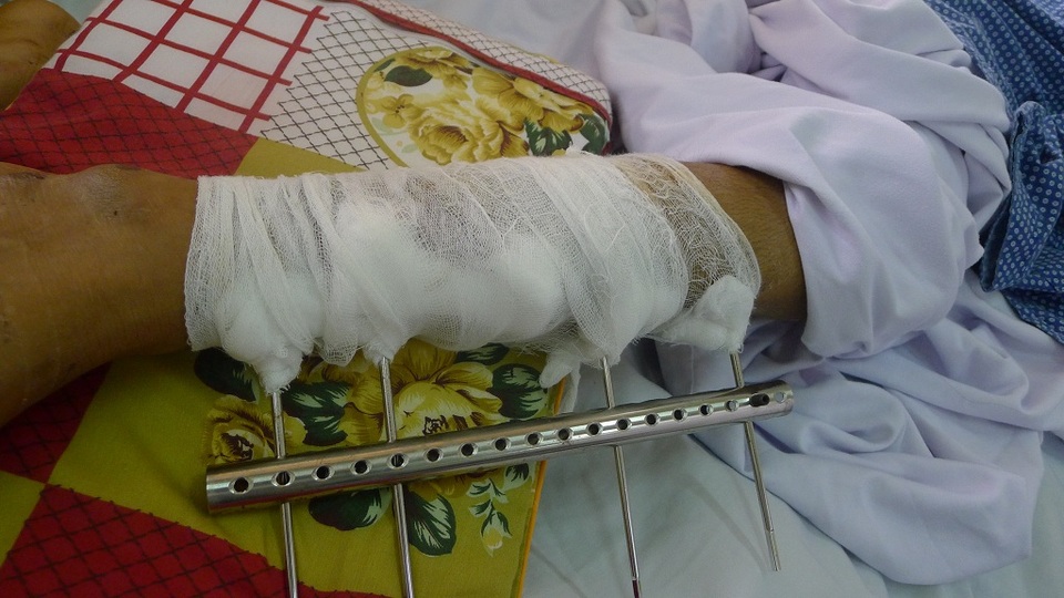 Đi làm thuê lấy tiền chữa bệnh cho mẹ, cậu bé dân tộc Dao bị tường đè dập phổi - 3 Tại bệnh viện em được nẹp cố định chân để chuẩn bị mổ.