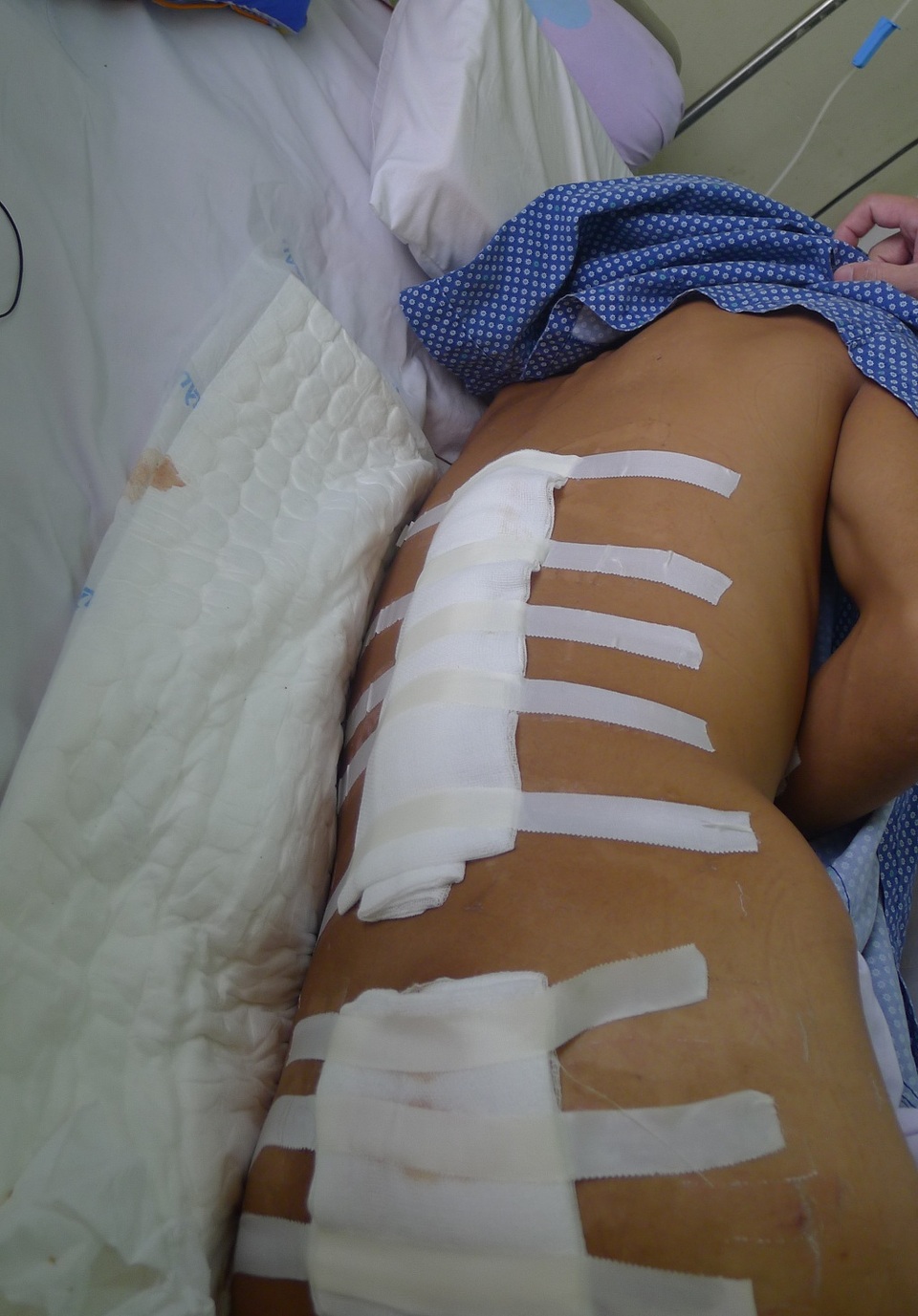 Đi làm thuê lấy tiền chữa bệnh cho mẹ, cậu bé dân tộc Dao bị tường đè dập phổi - 2 Em bị đa chấn thương, nguy kịch tính mạng.