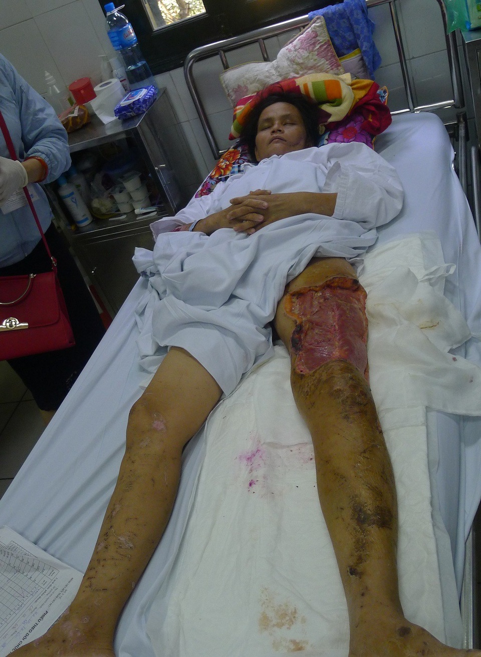 Chồng chết, vợ nguy kịch vì lũ cuốn trôi - 3 Chân chị Phiếu tổn thương nghiêm trọng.