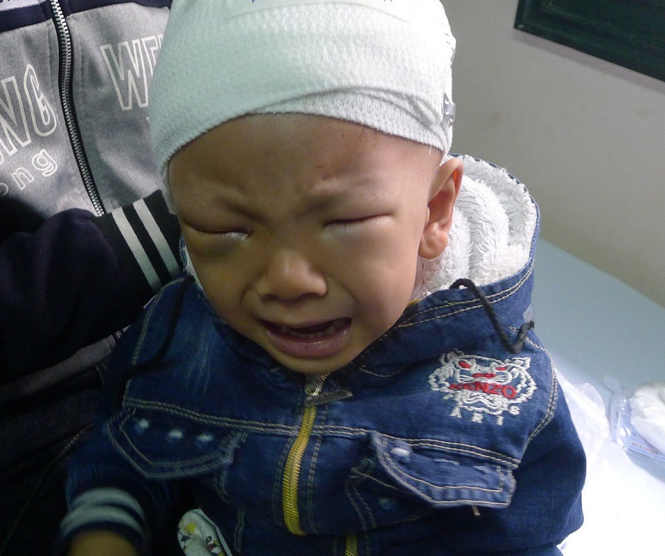 Đau đớn cảnh mẹ ung thư hạch, con ung thư võng mạc - 1 2 tuổi cậu bé Phúc bị ung thư võng mạc nên em phải mổ khoét mắt.
