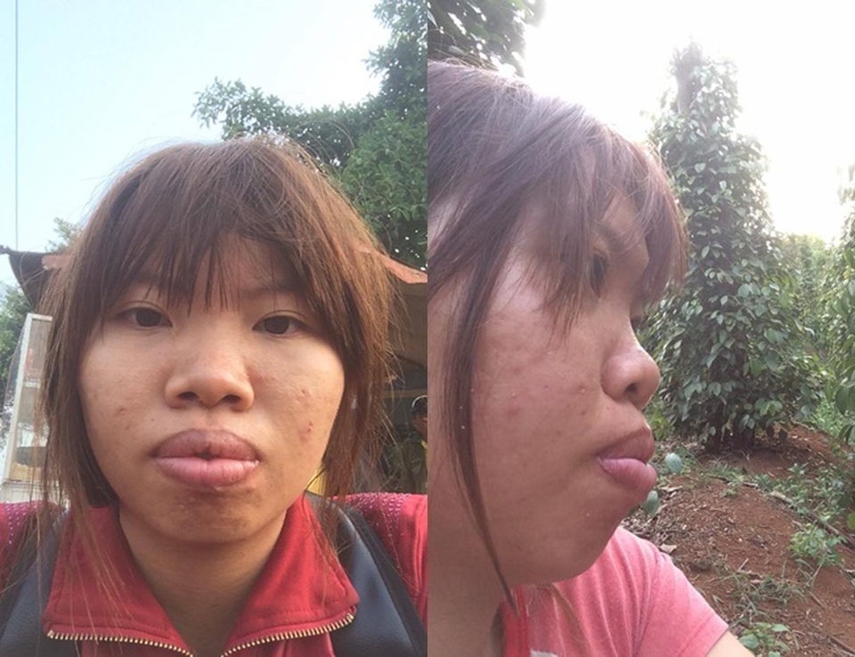 Những cô gái Việt “lột xác” ngoạn mục nhờ dao kéo - 1 Phượng sinh ra kém may mắn hơn các bạn khi có một ngoại hình xấu xí