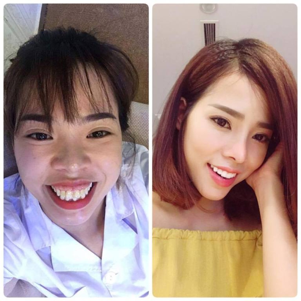 Cô gái chi 200 triệu "đập đi làm lại" khuôn mặt và giấc mơ 10 năm thành hiện thực - 2 Hình ảnh sau khi lột xác của cô gái Hà Nội.