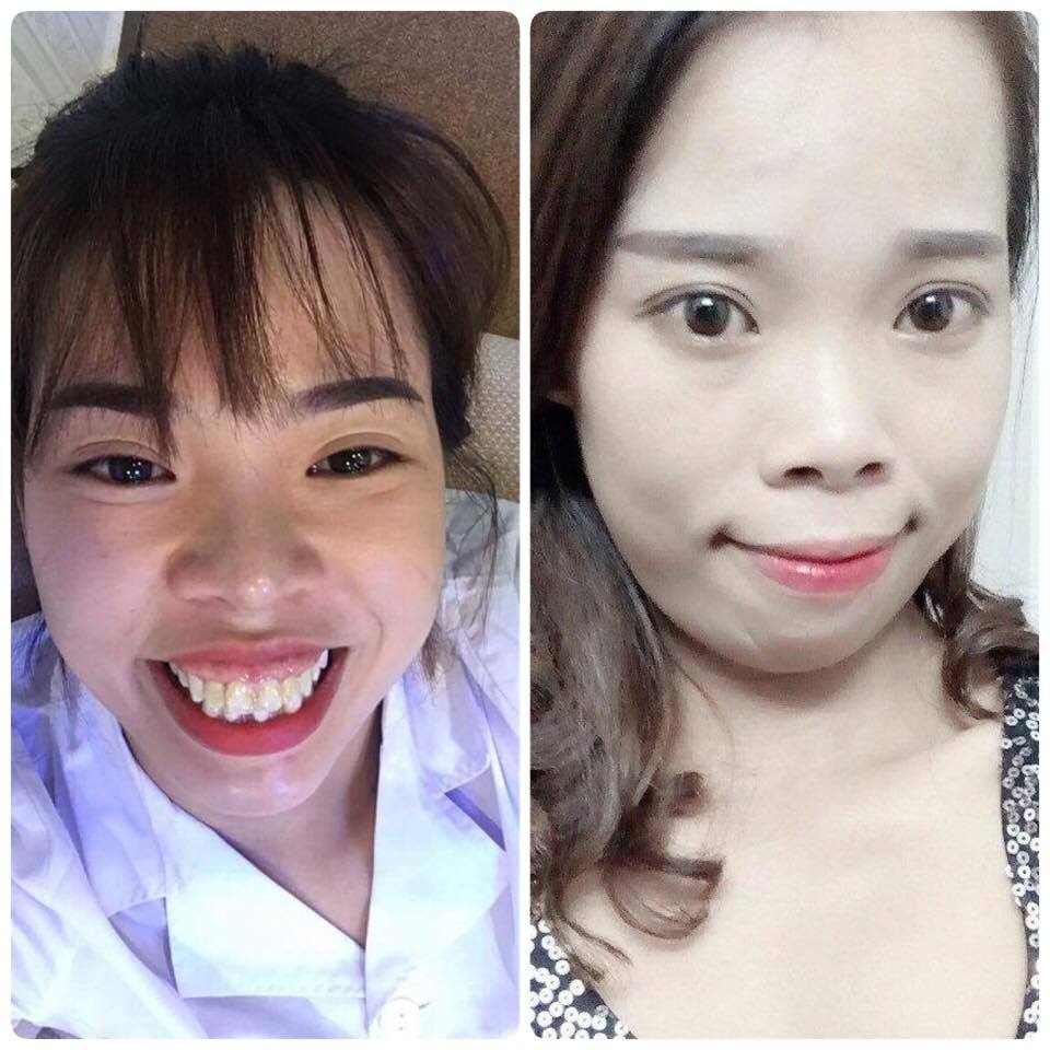 Cô gái chi 200 triệu "đập đi làm lại" khuôn mặt và giấc mơ 10 năm thành hiện thực - 1 Ngoại hình trước đây khiến Thủy tự ti và gây khó khăn cho cô trong việc giao tiếp.