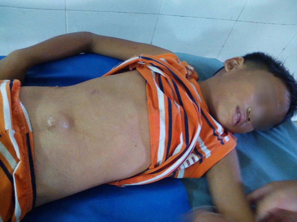 Hy hữu chuyện học sinh lớp 3 bị té dập gan - 1 Em Phi Rùm bị té dập gan do chạy xe đạp nhưng buông 2 tay