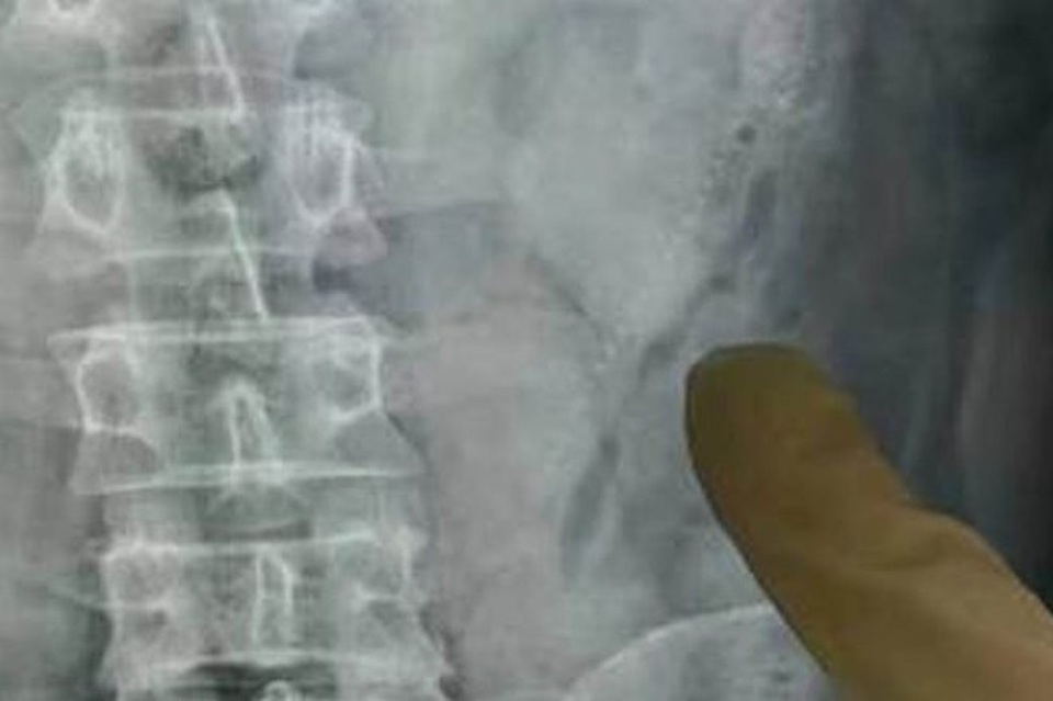 Suýt mất mạng vì nhét 2 con lươn vào hậu môn khi say xỉn - 1
Bác sỹ chụp x-quang để xác định vị trí hai con lươn.