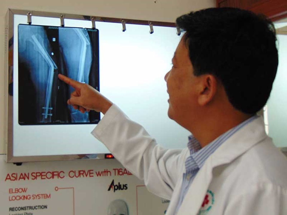 Đinh đóng vô người đừng quên lấy ra - 1
Kết quả chụp X-quang cho thấy cây đinh thép trong chân bệnh nhân N. bị gãy cong. Ảnh: TRẦN NGỌC