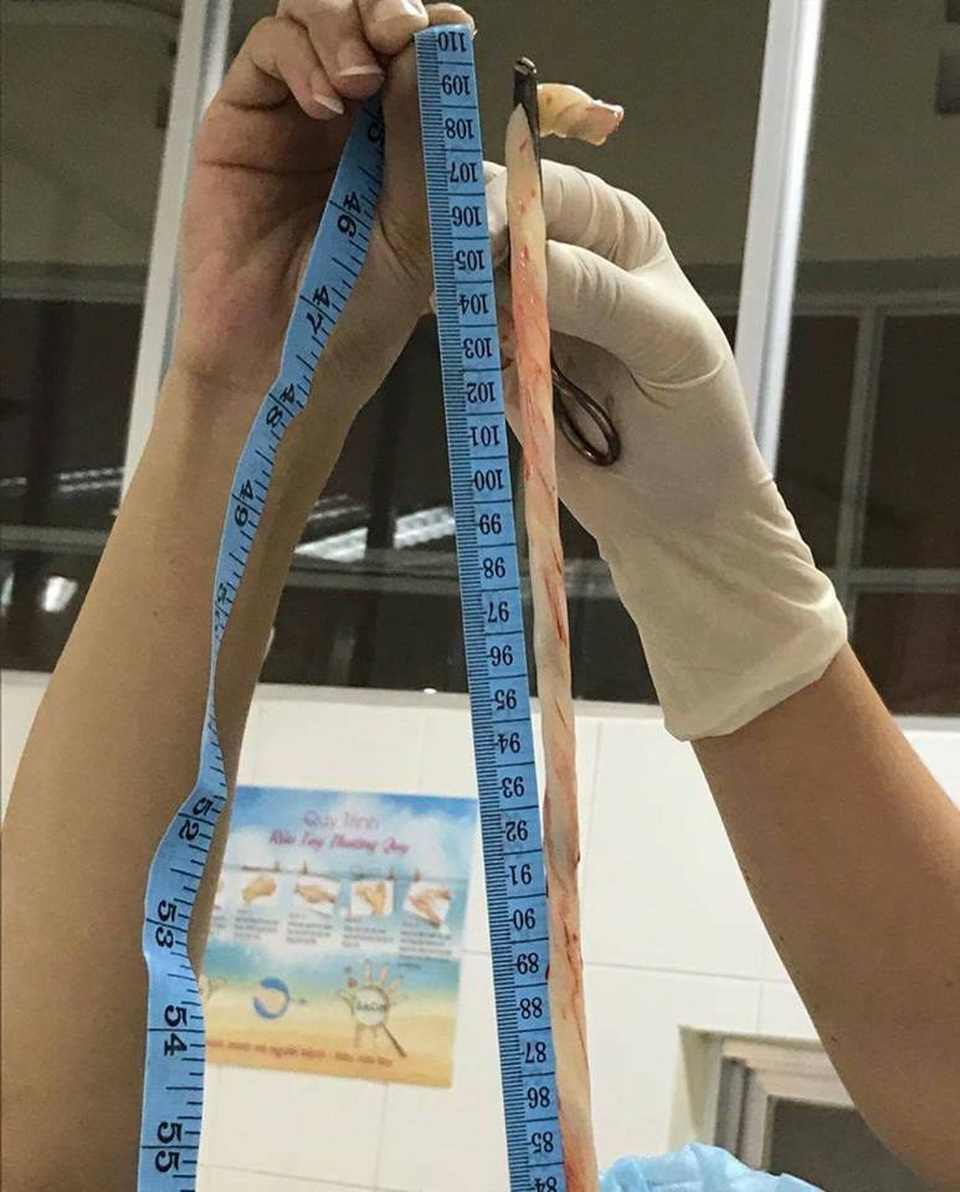 
Dây cuốn rốn dài đến 110 cm cuốn thành 4 vòng quanh cổ bé gái
