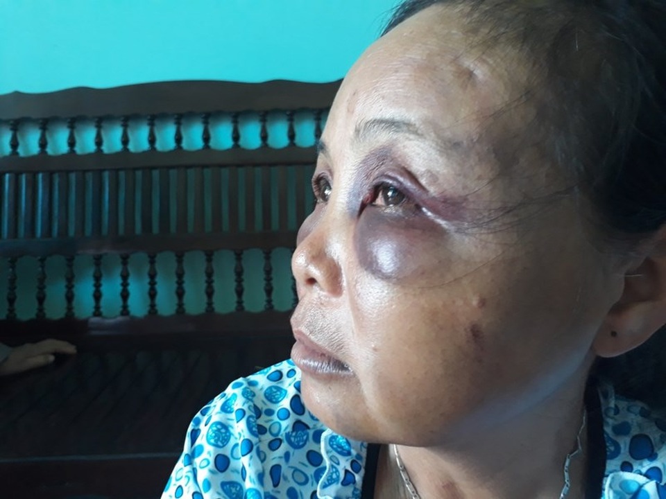 2 phụ nữ bị đánh vì nghi bắt cóc: Họ quá hung hãn! - 1 Bà Phúc bị đánh thâm tím mặt mày. Ảnh: TUYẾN PHAN