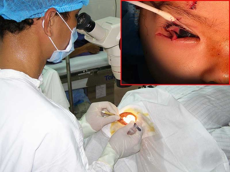 Múc bỏ mắt do tai nạn bất ngờ - 1 Bác sĩ đang phẫu thuật cho một bệnh nhân bị chấn thương mắt. Ảnh: TRẦN NGỌC. Mắt phải của một trẻ bị vỡ nhãn cầu do vật cứng, sắc nhọn văng trúng (ảnh nhỏ). Ảnh: NGUYÊN PHẠM