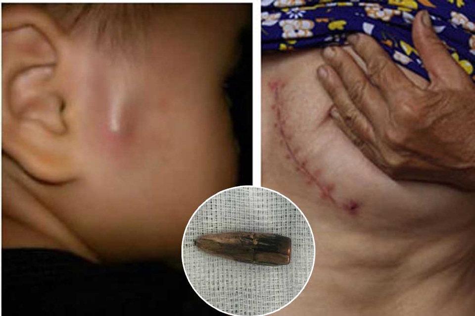 
Hình ảnh đầu đạn nằm trong má cháu Nguyễn Hải Phong (trái), vết mổ lấy đầu đạn trên người bà Lý (phải) và viên đạn được lấy ra từ ngực bà Lý (ảnh nhỏ).
