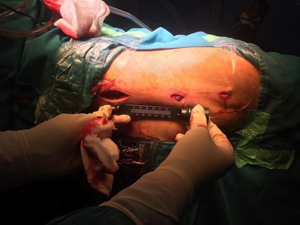 Chỉ cần 3 vết rạch qua da để can thiệp bảo tồn khớp, cụ ông thoát khỏi một cuộc đại phẫu