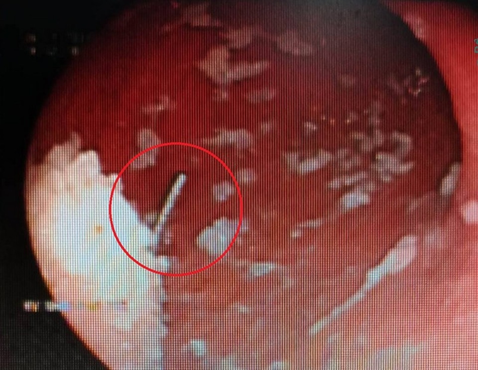 'Biểu diễn' không thành, kim may chui tọt vô bụng - 1 Nội soi cho thấy kim may cắm vào thực quản bệnh nhân. Ảnh: BV 115
