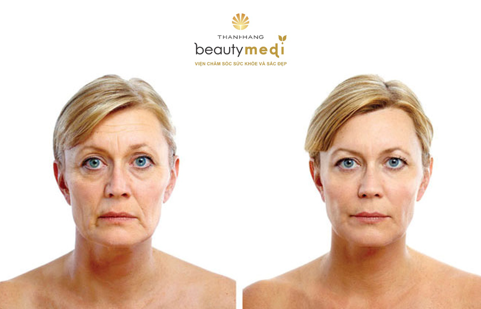 Chuyên gia làm đẹp tư vấn chi tiết về công nghệ nâng cơ chỉ bằng vàng - 1 Nâng cơ chỉ là liệu pháp trẻ hóa thịnh hành giúp nhanh chóng lấy lại 10 năm tuổi xuân