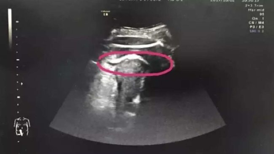 Thai nhi đạp thủng tử cung của mẹ