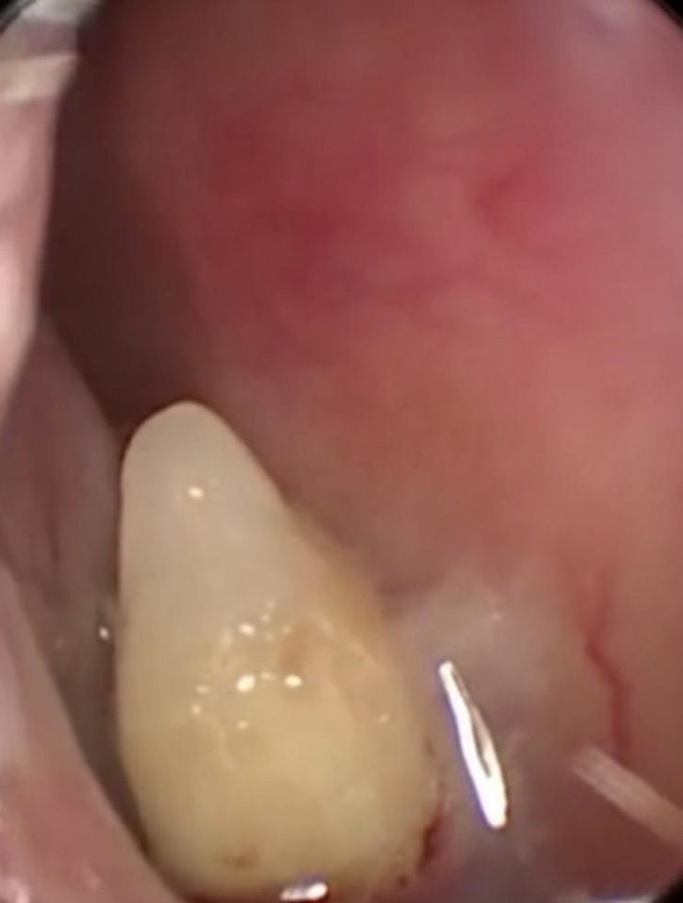 Lạ đời mũi biết... mọc răng - 1 Chiếc răng đã thành hình đầy đủ trong mũi cô Xia