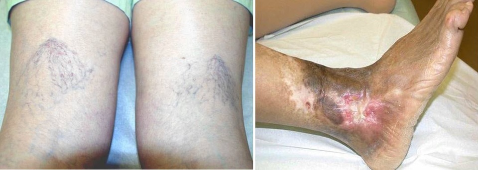 Suy tĩnh mạch chân – đừng để nhẹ thành nặng - 1 Hình trái- Bệnh nhân suy tĩnh mạch gấp độ nhẹ; Hình bên phải- Bệnh nhân suy tĩnh mạch nặng bị biến đổi sắc tố da kèm vết loét đã lành