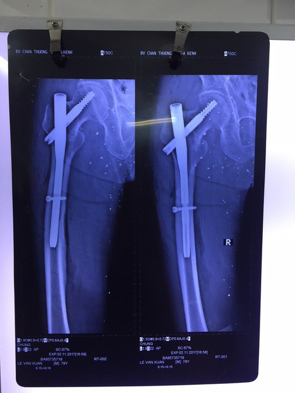Kỹ thuật bắt đinh vít can thiệp khớp này mang nhiều lợi điểm cho người bệnh