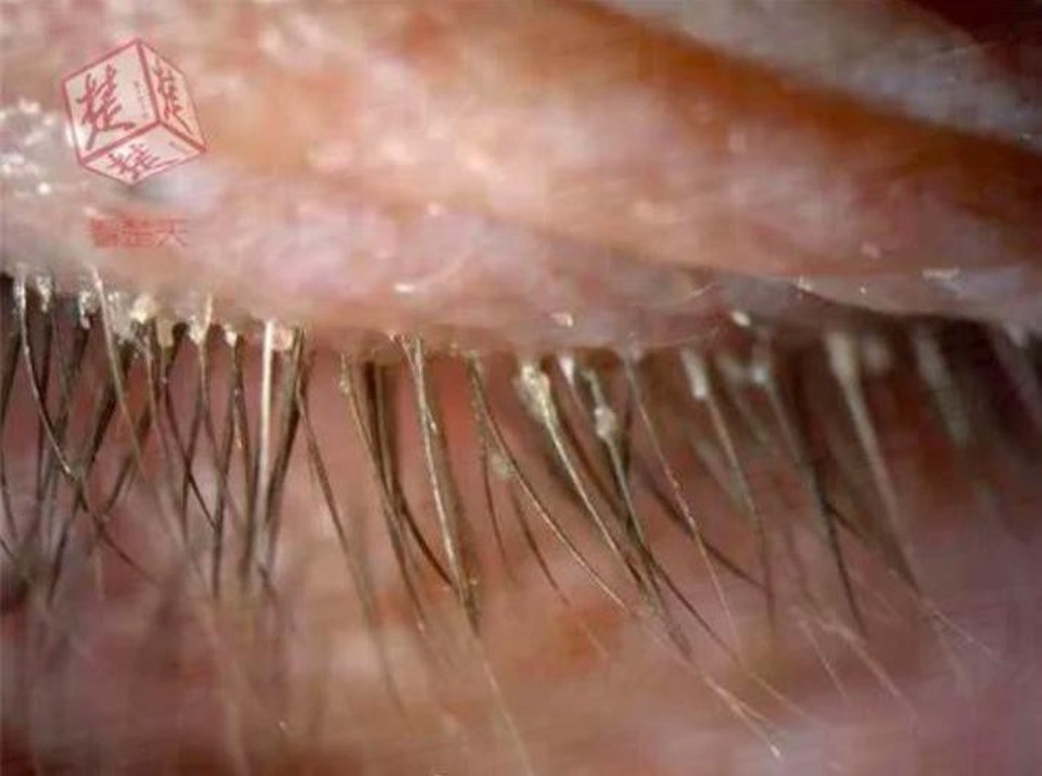 Sau 2 năm chịu đựng, cô Xu mới đến khám bác sĩ nhãn khoa