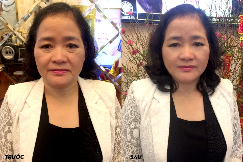 “Giải cứu” làn da lão hóa cùng chuyên gia Ý nhận ưu đãi khủng 50% - 3 Một khách hàng trẻ hóa da trực tiếp được Dr. Vincenzo Mancini điều trị