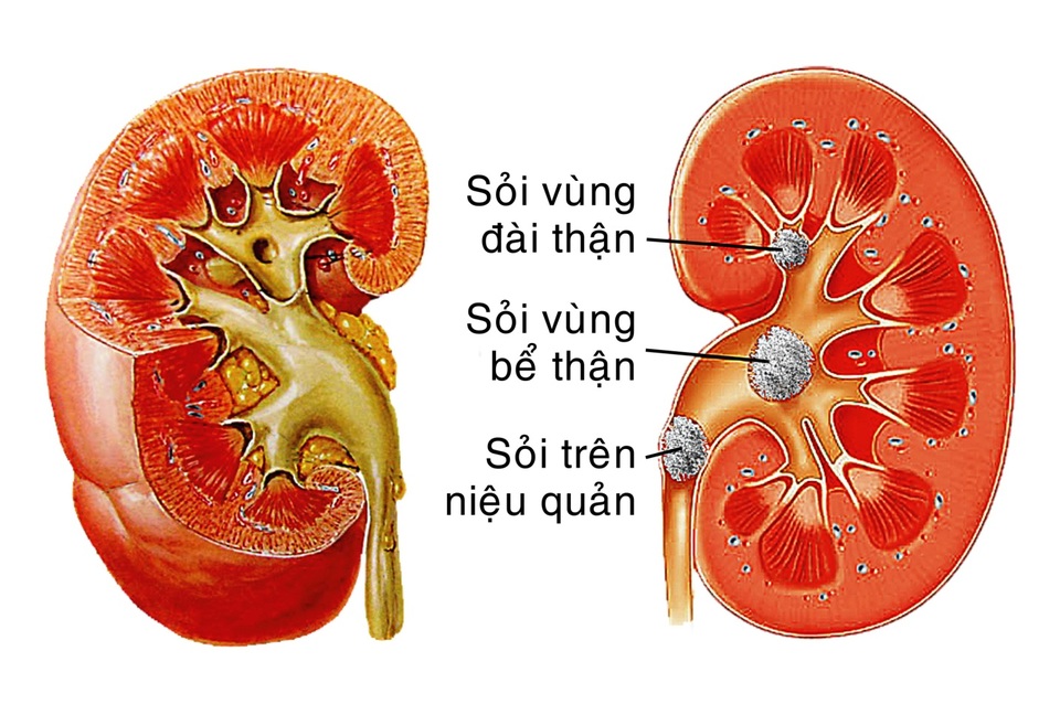 Tác động nghiêm trọng của sỏi thận đến cơ thể - 2 Điều trị sỏi thận phụ thuộc vào 2 yếu tố chính: kích thước và vị trí của sỏi ( ảnh minh họa)