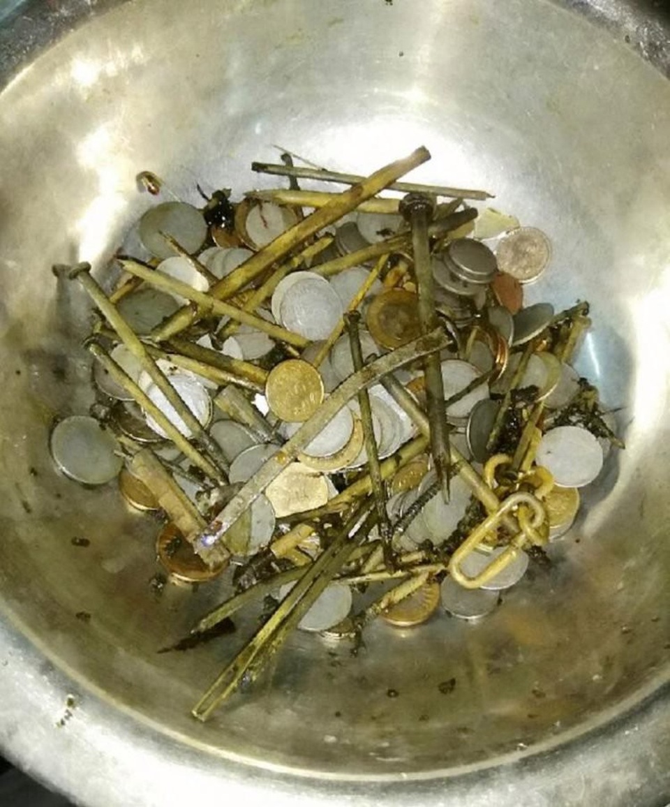 Kinh dị bệnh nhân nuốt 7kg tiền xu, đinh ốc vào bụng vì bị trầm cảm - 2 Bệnh nhân nuốt 7kg dị vật vì trầm cảm
