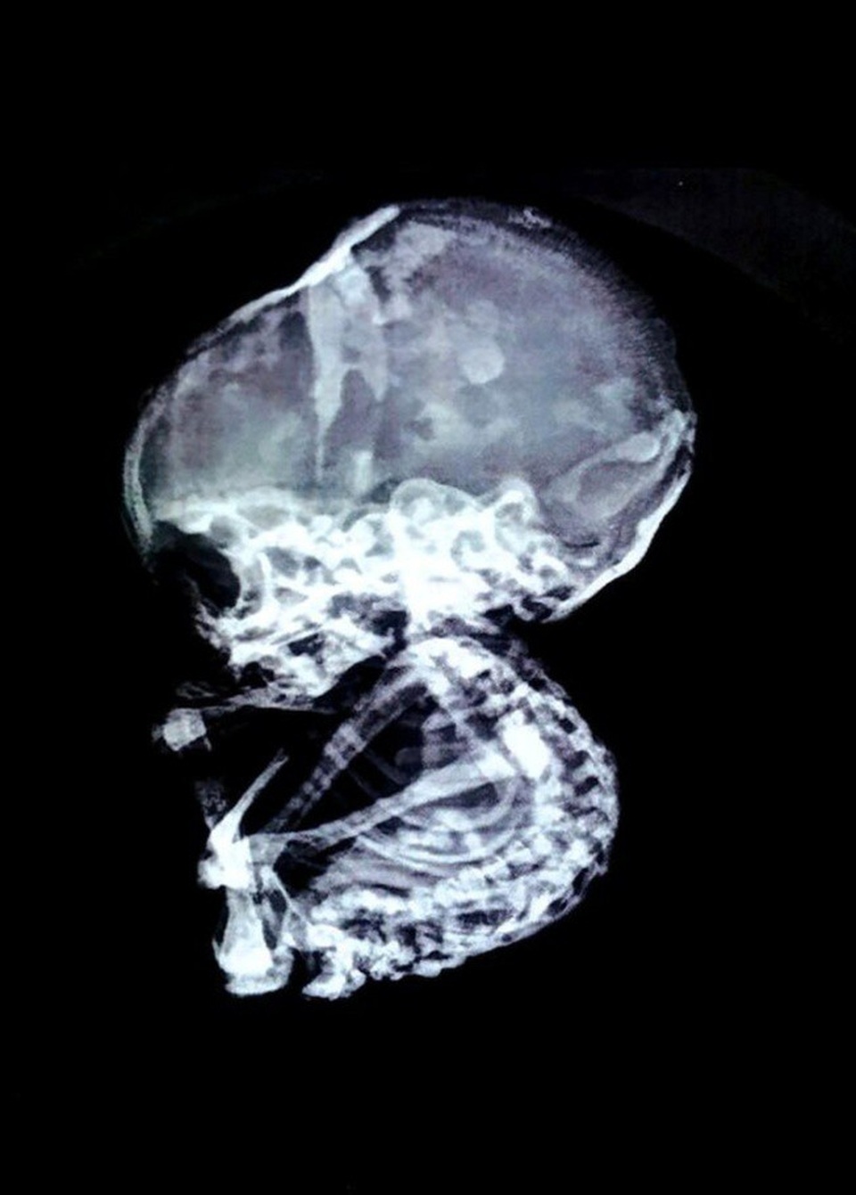 
Thai nhi hóa đá khi 4 tháng tuổi và đã phát triển tương đối đầy đủ trong bụng mẹ
