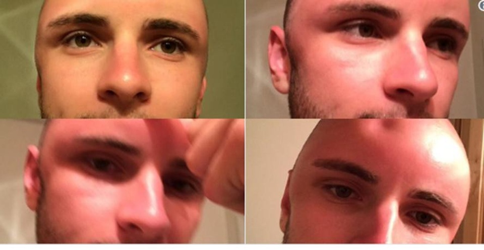 Làn da của anh cũng bị bỏng rát cả tuần liền