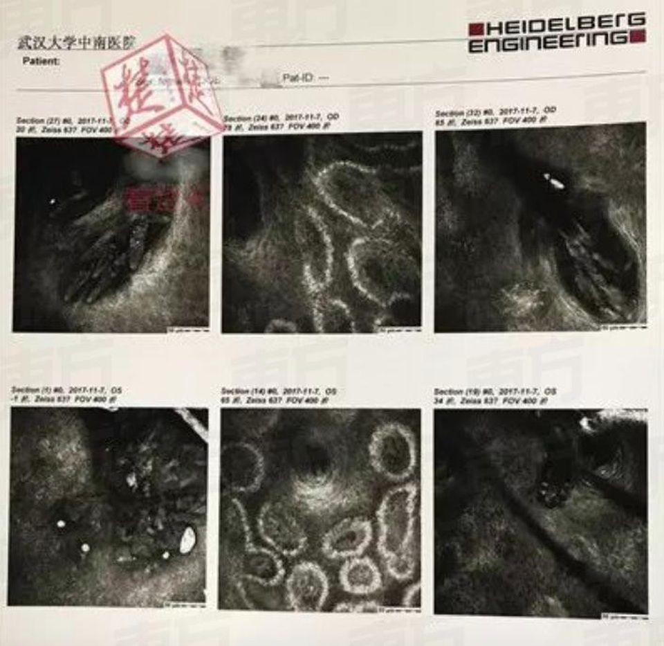 Lông mi và mí mắt của cô dính lại với nhau vì số lượng ký sinh trùng khổng lồ