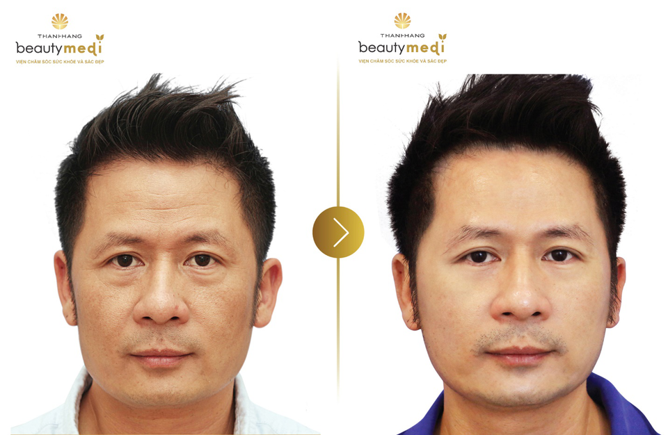 Chuyên gia làm đẹp tư vấn chi tiết về công nghệ nâng cơ chỉ bằng vàng - 3 Hình ảnh trước và sau khi nam ca sĩ Bằng Kiều thực hiện phương pháp Nâng cơ chỉ
