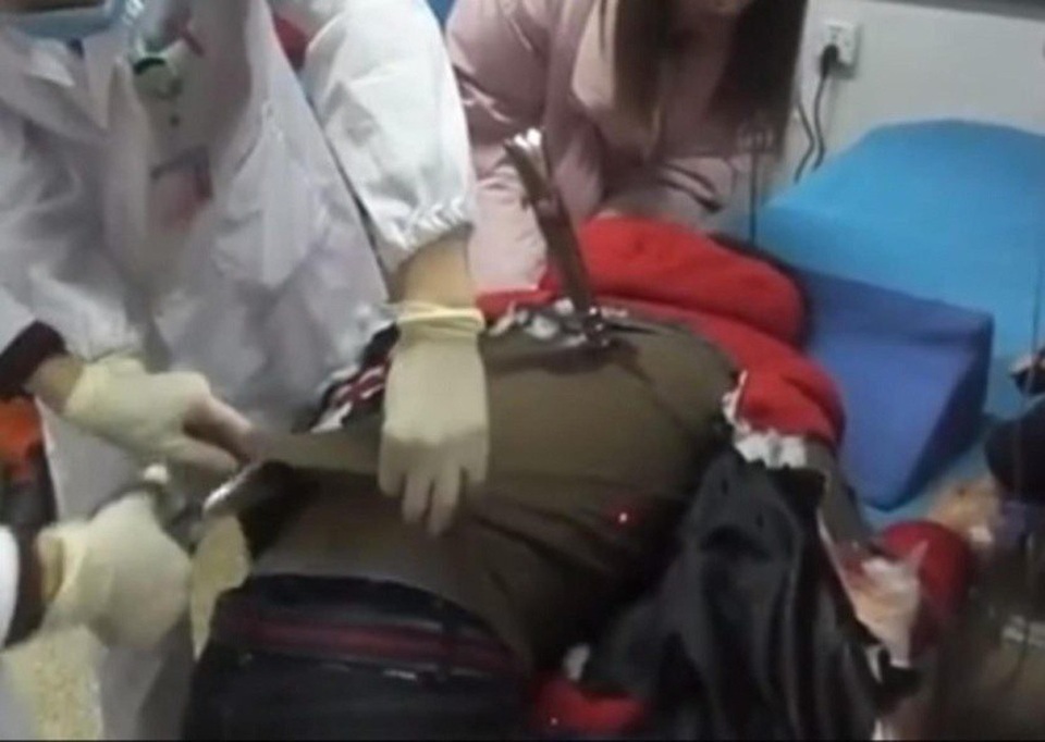 Rùng mình một ca bỗng nhiên bị ngọn giáo lao tới đâm xuyên người - 3 Các bác sĩ tiến hành cấp cứu tạm thời và cưa bớt ngọn giáo