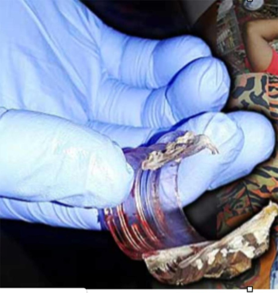 Kẹt "của quý" trong chai, cuống cuồng dùng cưa cắt trong bất lực - 2 Kẹt "của quý" trong chai, cuống cuồng dùng cưa cắt trong bất lực - 2