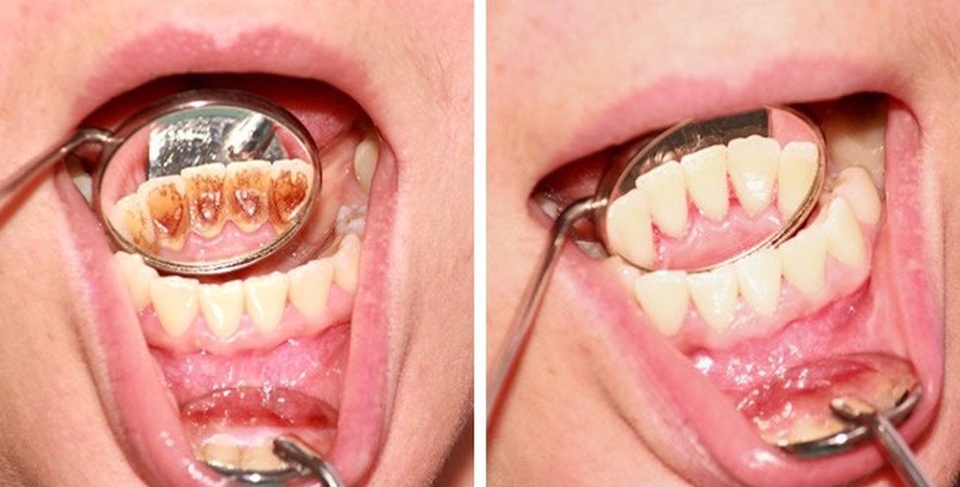 8 sai lầm phổ biến khi chăm sóc răng - 5 8 sai lầm phổ biến khi chăm sóc răng - 5